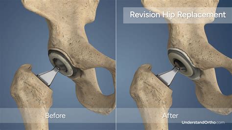 hip surgery aberdeen|PHIN .